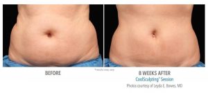 coolsculpting treatment center before and after