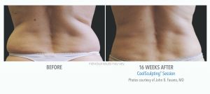 coolsculpting treatment center before and after