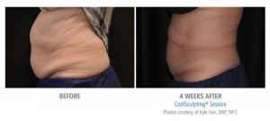 coolsculpting treatment center before and after