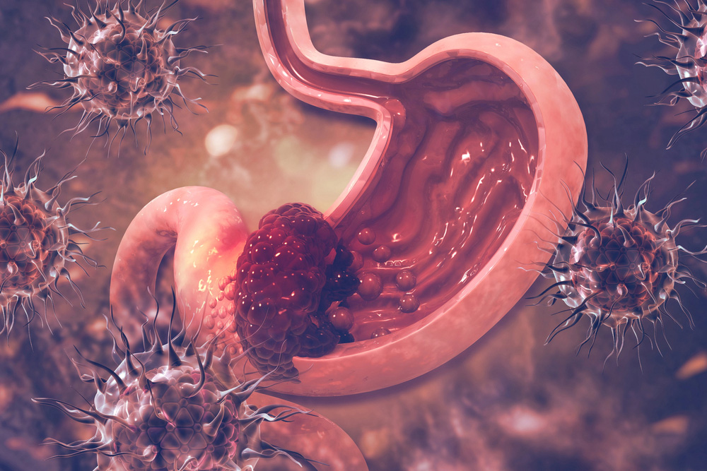 Signs And Symptoms Of Stomach Cancer That Often Go Unnoticed
